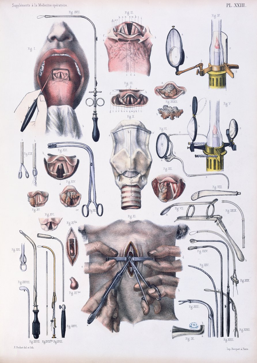Trakeotomi operasyonu, Jean-Baptiste Marc Bourgery (1797-1849) 1866-67