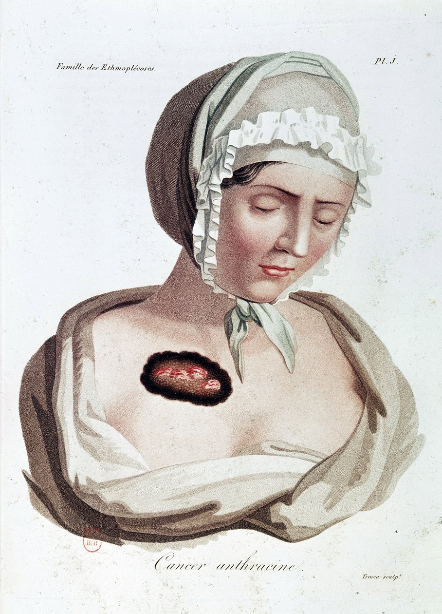 Antrasin Kanseri - Alibert, B.N. by Jean Louis Alibert