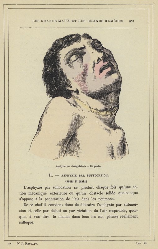 Boğularak boğulma, Asılmış bir adam (renkli taş) by French School